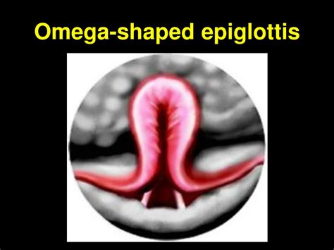 omega shaped epiglottis